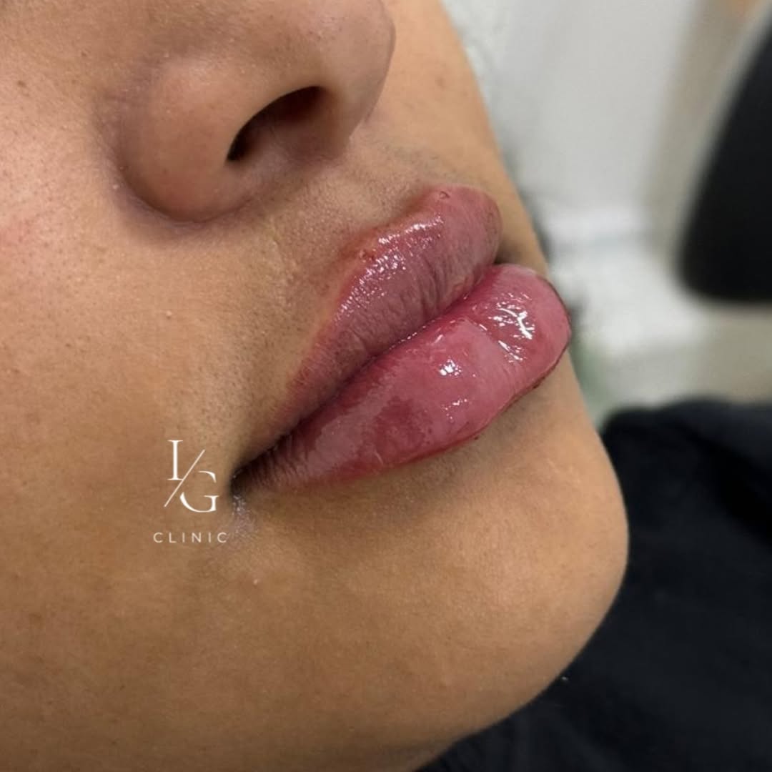 Resultado de harmonização facial realizada na IG CLINIC - procedimento estético seguro e natural