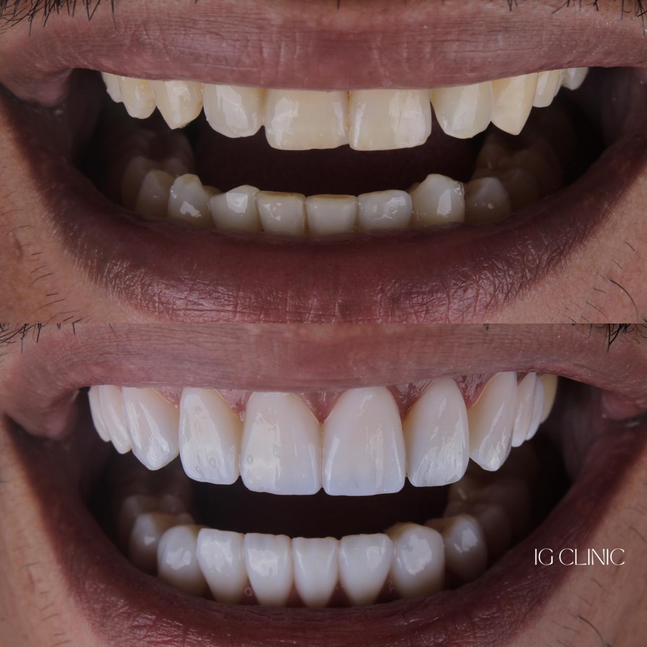Antes e depois - Lentes de resina IG CLINIC - transformação natural do sorriso
