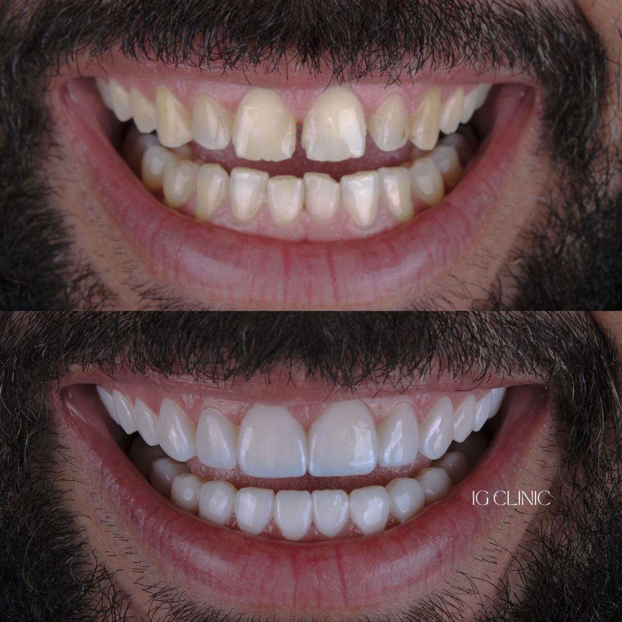 Lentes de resina IG CLINIC - restauração completa e natural do sorriso