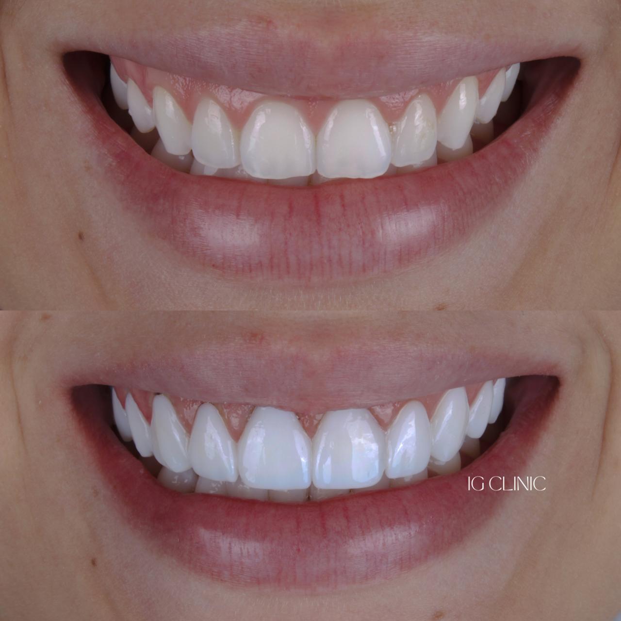 Lentes de resina IG CLINIC - sorriso perfeito e harmonioso