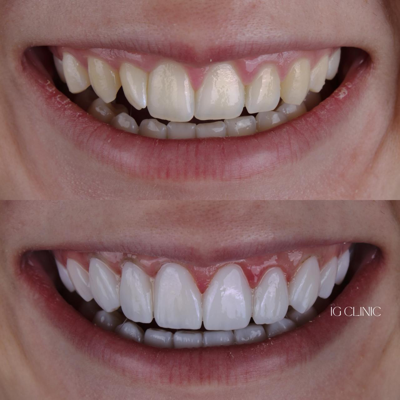 Lentes de resina IG CLINIC - resultado natural com dentes brancos e saudáveis