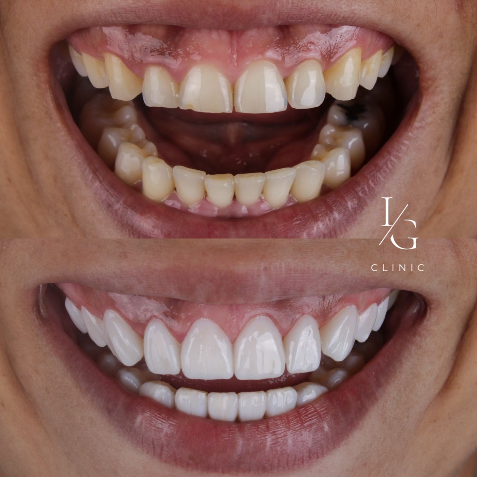 Lentes de resina IG CLINIC - resultado natural e duradouro