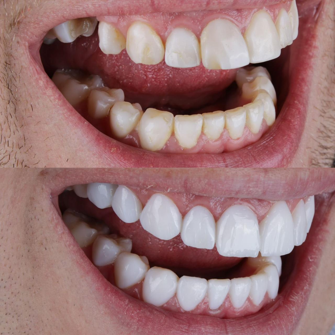 Sorriso restaurado com prótese fixa moderna na IG CLINIC - resultado natural e duradouro